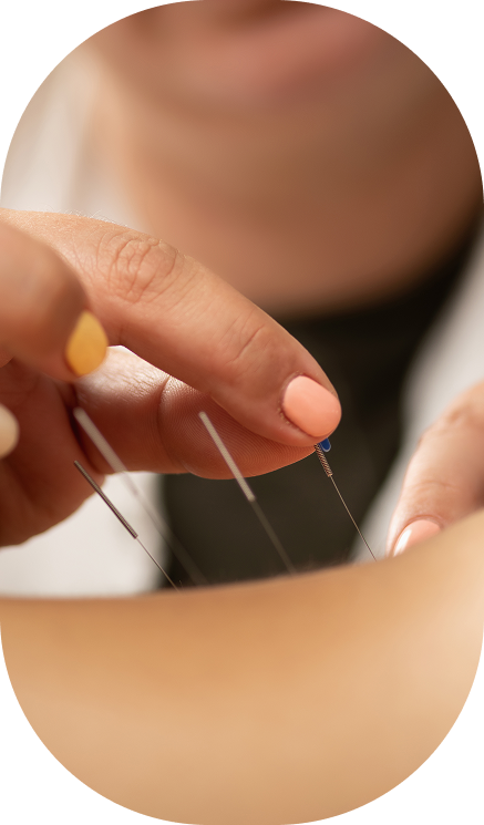 close up of fingers placing acupuncture needles