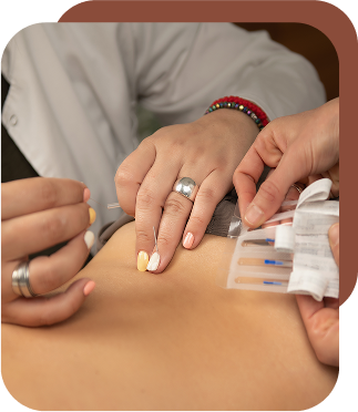 doctor performing acupuncture
