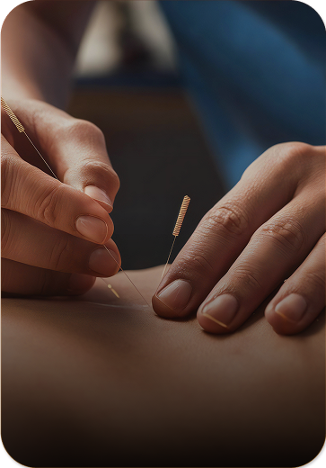 doctors hands placing acupuncture needles