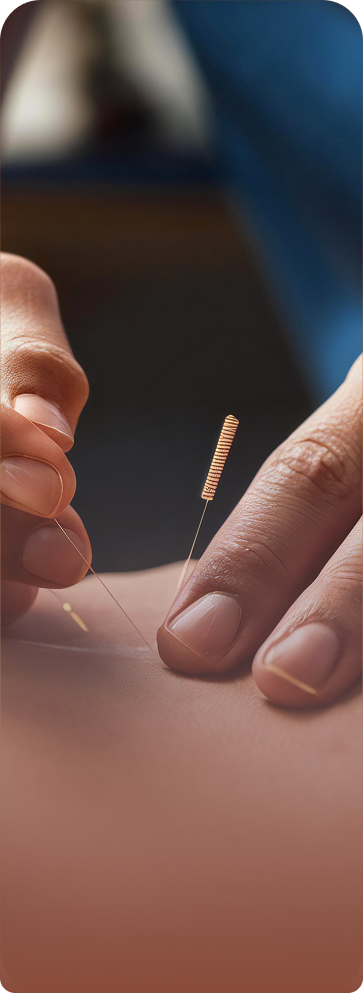 closeup of fingers placing acupuncture needles